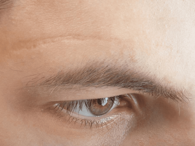 Laser Scar Removal in Lucknow Scar Removal Surgery Cost