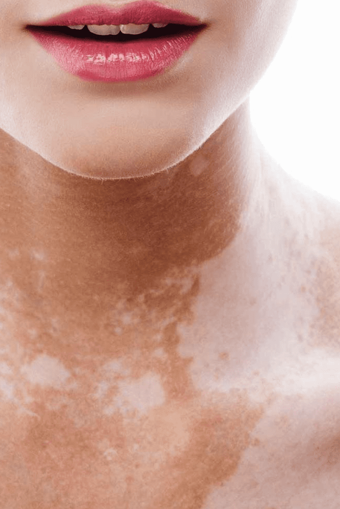 Vitiligo Surgery | Plastic Surgery for Vitiligo, Lucknow Plastic Surgery Clinic