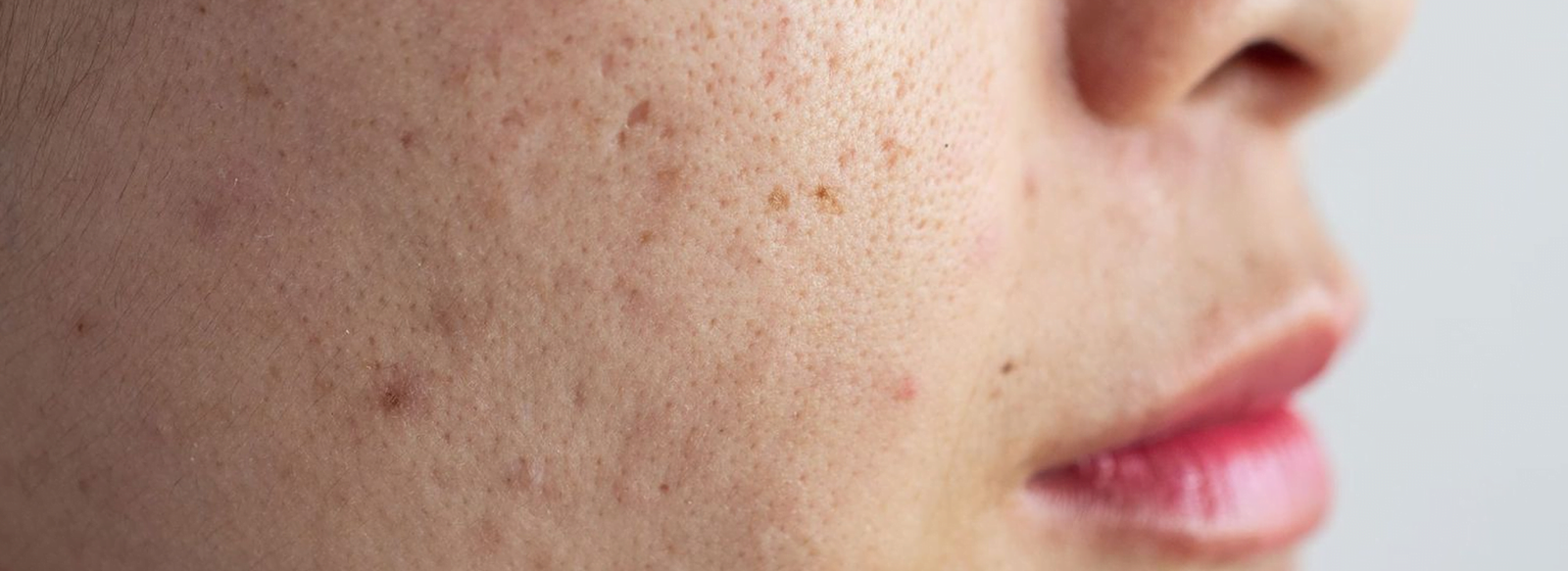 Laser Scar Removal in Lucknow Scar Removal Surgery Cost